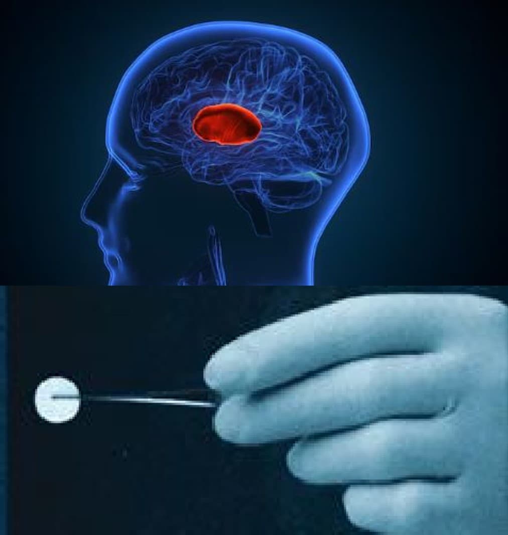 How a Biodegradable Implant Revolutionized Brain Cancer Care